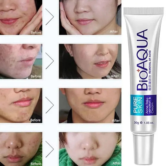 BioAqua PureSkin - Creme para tratamento de acne,cicatrizes e anti oliosidade